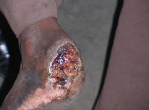 Photo of badly infected heal